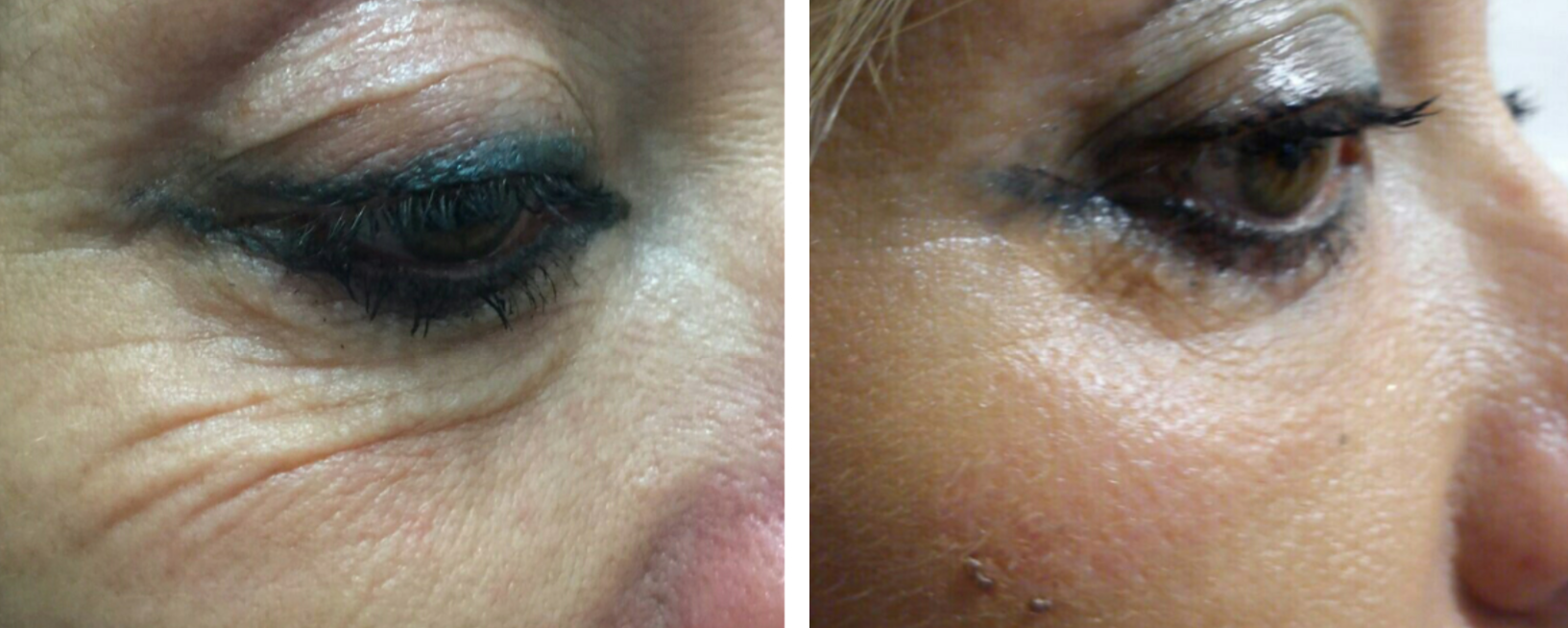resurfacing-paupiere-laser-co2