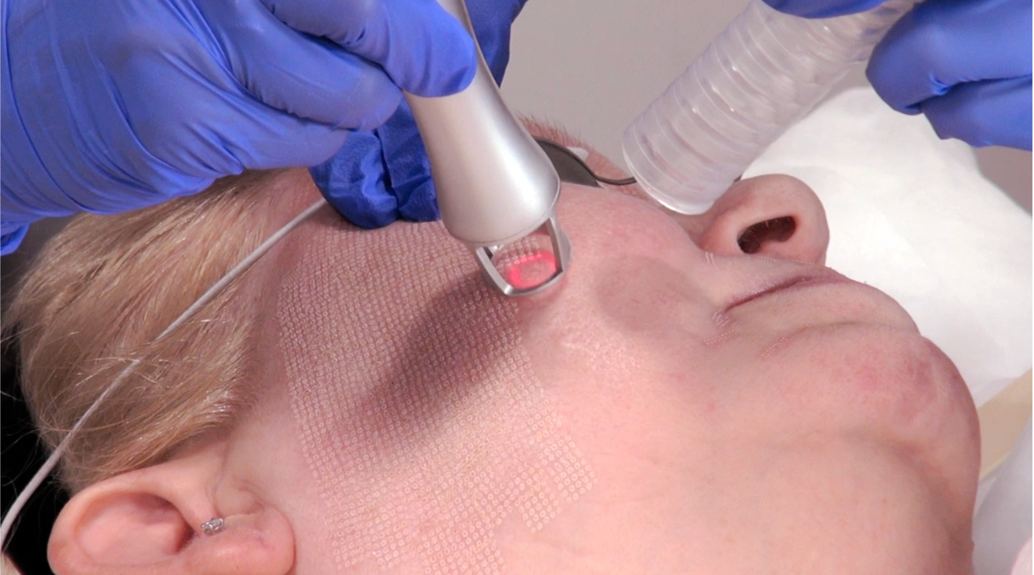 resurfacing-rides-laser-co2